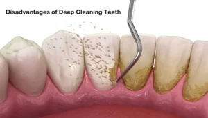 Disadvantages-of-Deep-Cleaning-Teeth
